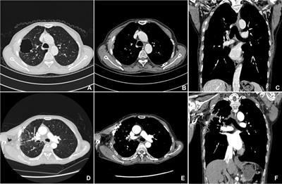 Case report: Primary pleural squamous cell carcinoma in a 68-year-old male